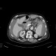 Rupture of the spleen: CT - Computed tomography